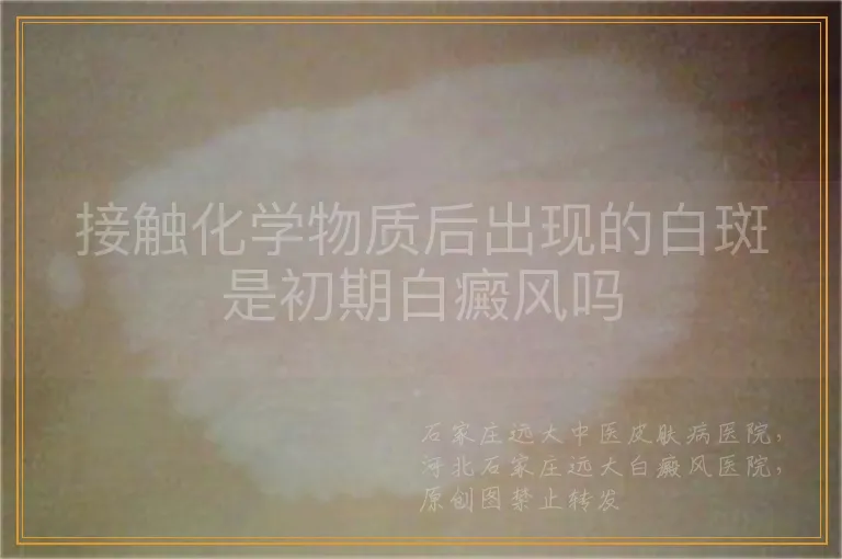 接触化学物质后出现的白斑是初期白癜风吗
