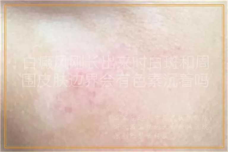 白癜风刚长出来时白斑和周围皮肤边界会有色素沉着吗