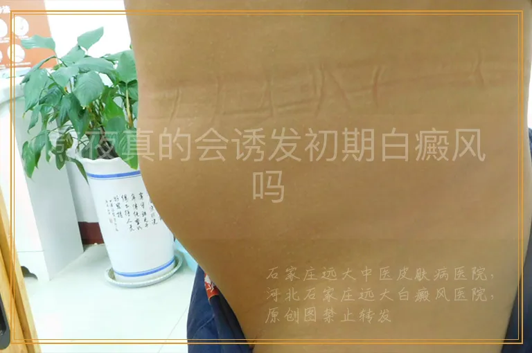 熬夜真的会诱发初期白癜风吗
