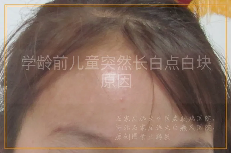 学龄前儿童突然长白点白块原因