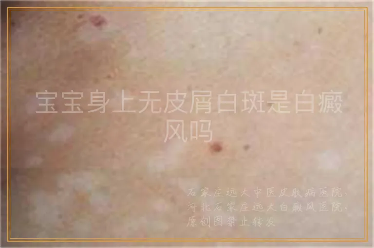 宝宝身上无皮屑白斑是白癜风吗