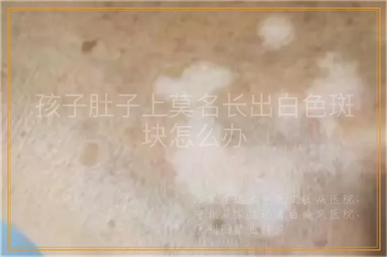 孩子肚子上莫名长出白色斑块怎么办