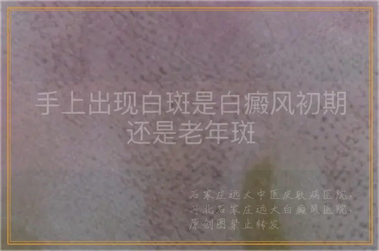 手上出现白斑是白癜风初期还是老年斑
