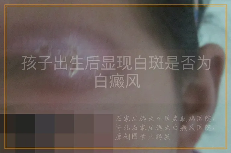 孩子出生后显现白斑是否为白癜风