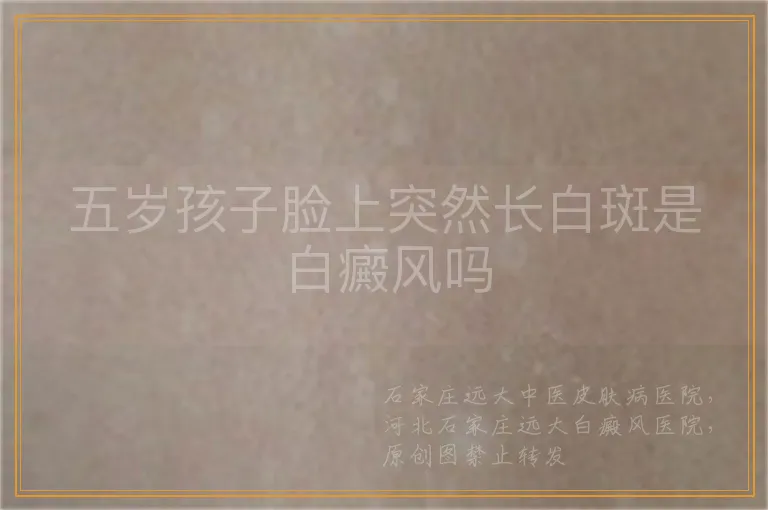 五岁孩子脸上突然长白斑是白癜风吗