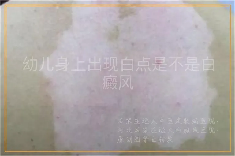 幼儿身上出现白点是不是白癜风