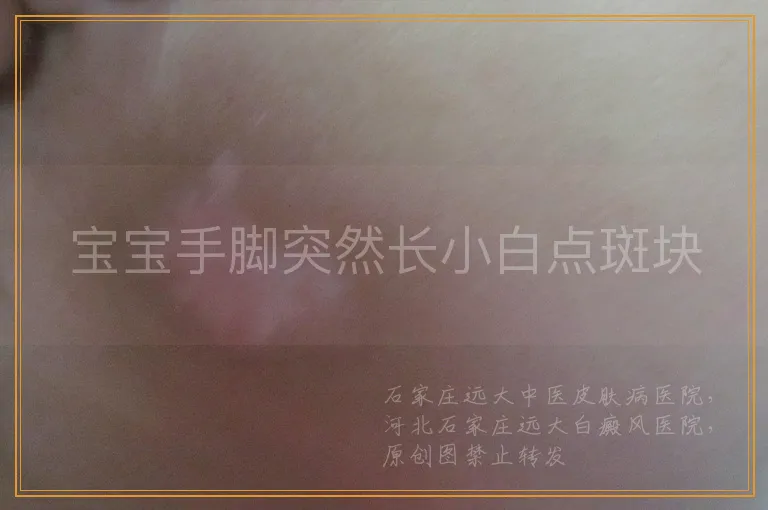 宝宝手脚突然长小白点斑块
