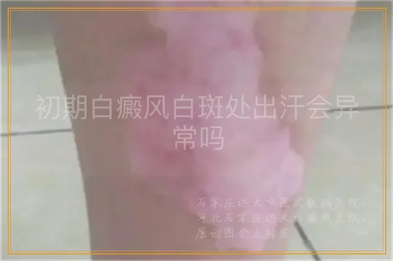 初期白癜风白斑处出汗会异常吗