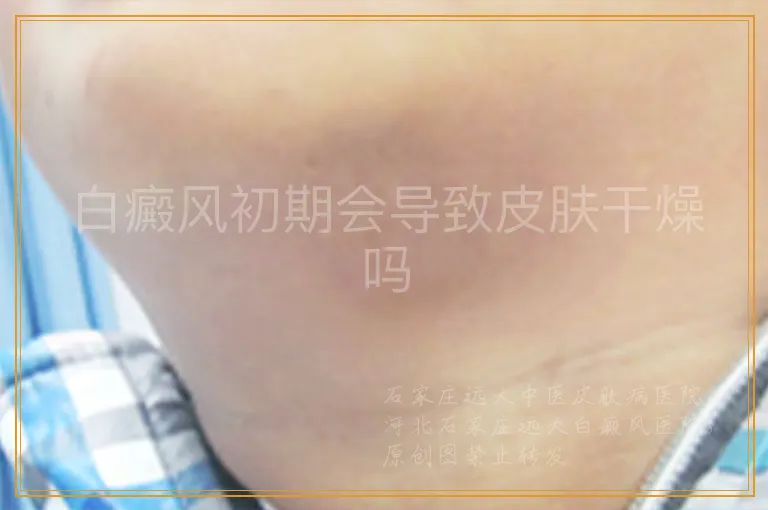 白癜风初期会导致皮肤干燥吗