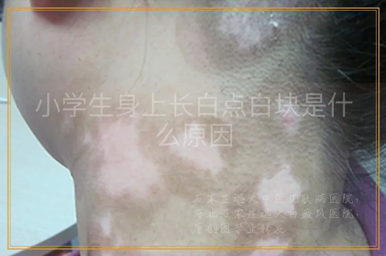 小学生身上长白点白块是什么原因