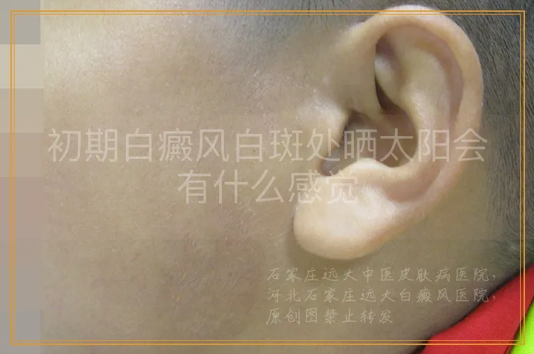 初期白癜风白斑处晒太阳会有什么感觉
