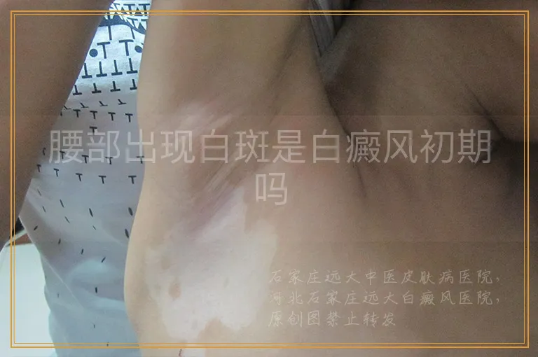 腰部出现白斑是白癜风初期吗