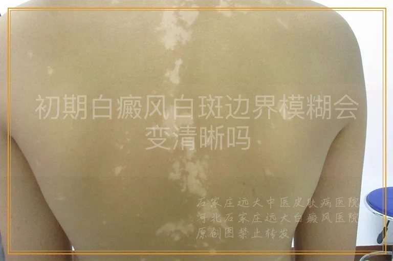 初期白癜风白斑边界模糊会变清晰吗