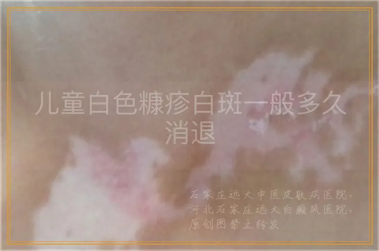 儿童白色糠疹白斑一般多久消退