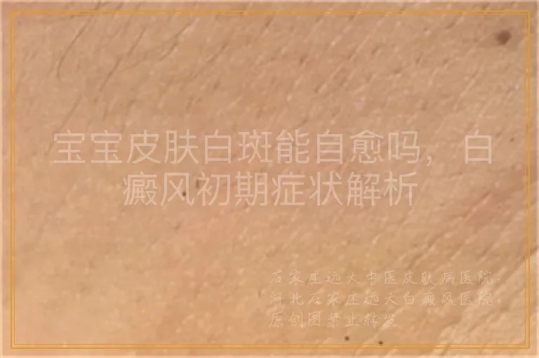 宝宝皮肤白斑能自愈吗，白癜风初期症状解析