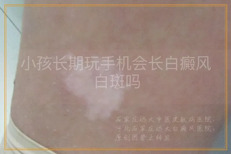 小孩长期玩手机会长白癜风白斑吗