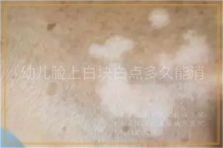 幼儿脸上白块白点多久能消