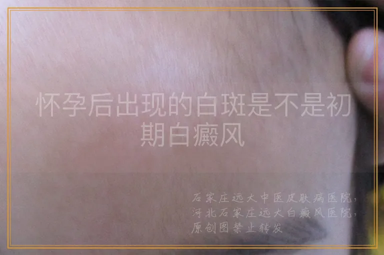 怀孕后出现的白斑是不是初期白癜风