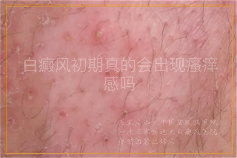 白癜风初期真的会出现瘙痒感吗