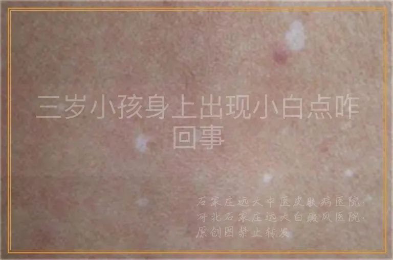 三岁小孩身上出现小白点咋回事