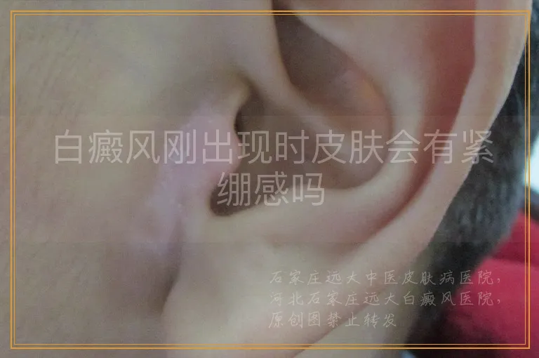 白癜风刚出现时皮肤会有紧绷感吗