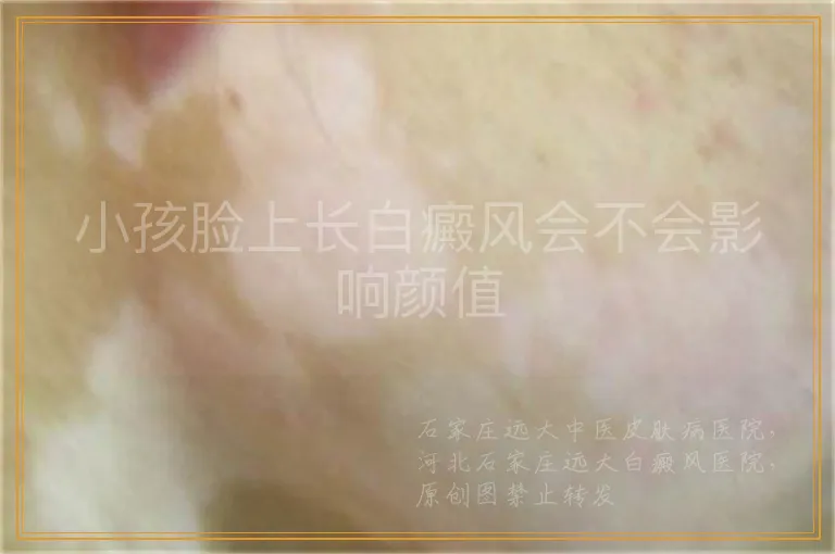 小孩脸上长白癜风会不会影响颜值