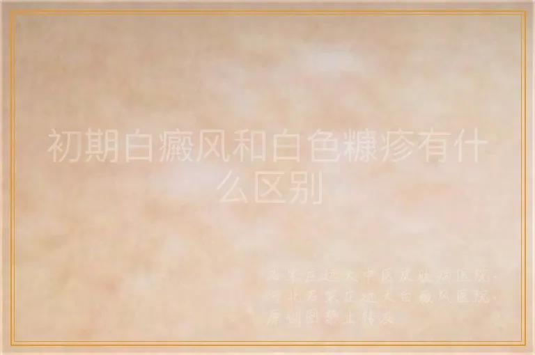 初期白癜风和白色糠疹有什么区别