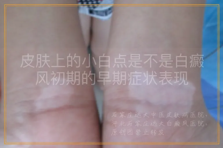 皮肤上的小白点是不是白癜风初期的早期症状表现