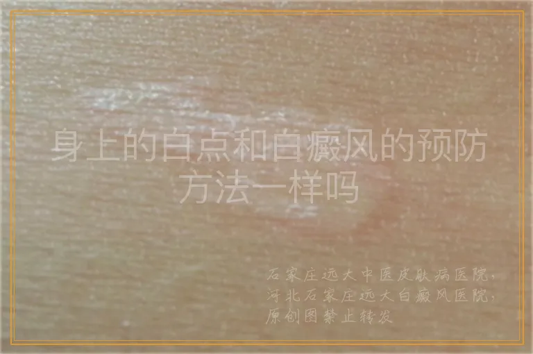 身上的白点和白癜风的预防方法一样吗