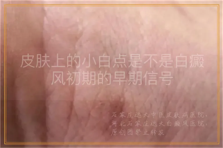 皮肤上的小白点是不是白癜风初期的早期信号