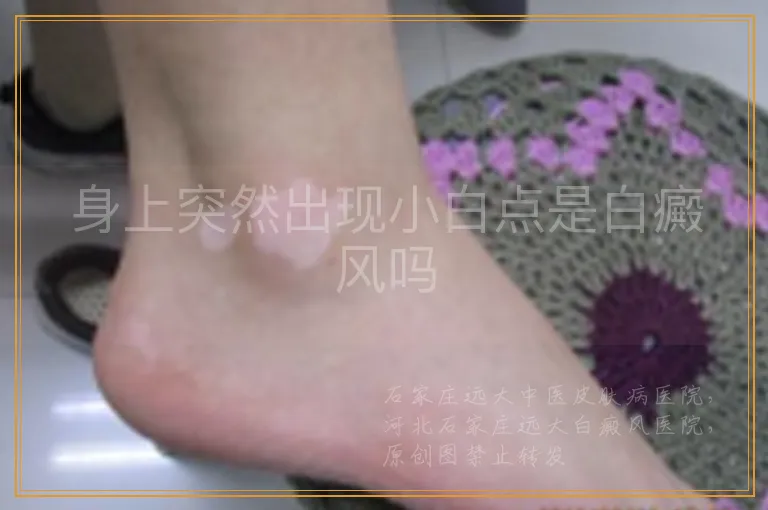 身上突然出现小白点是白癜风吗
