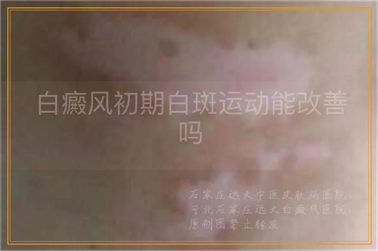 白癜风初期白斑运动能改善吗
