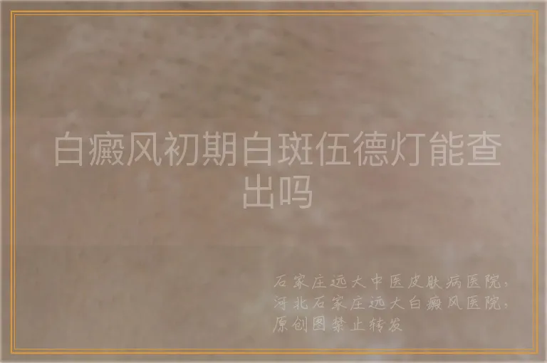 白癜风初期白斑伍德灯能查出吗