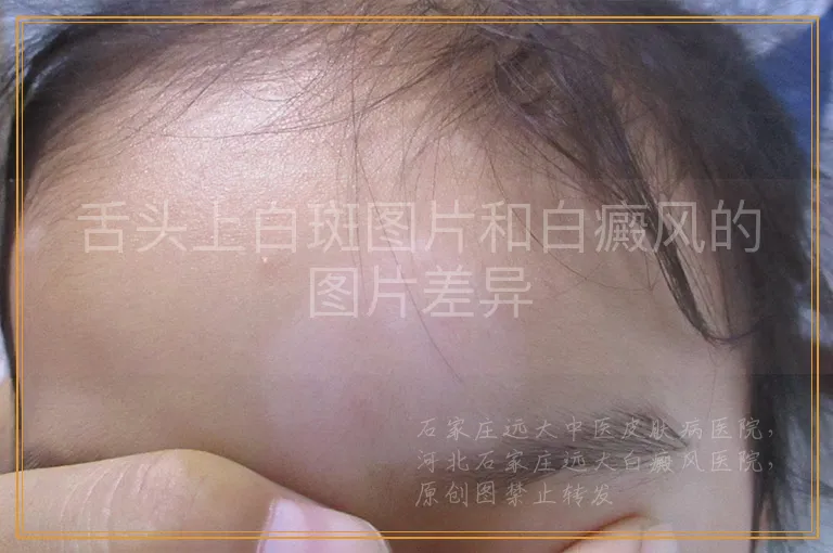 舌头上白斑图片和白癜风的图片差异