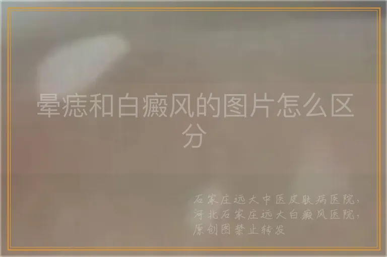 晕痣和白癜风的图片怎么区分