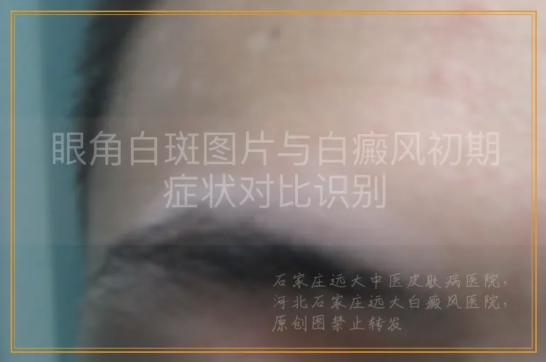 眼角白斑图片与白癜风初期症状对比识别