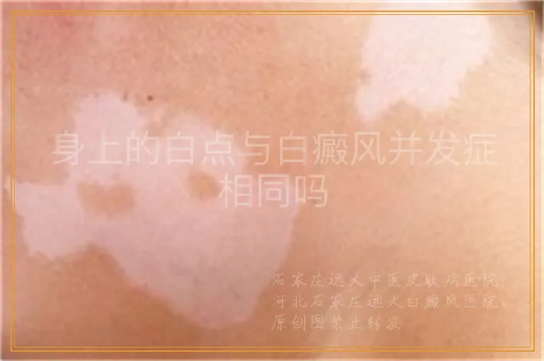 身上的白点与白癜风并发症相同吗