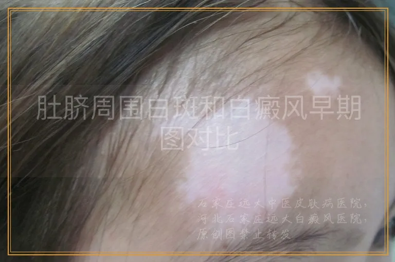 肚脐周围白斑和白癜风早期图对比