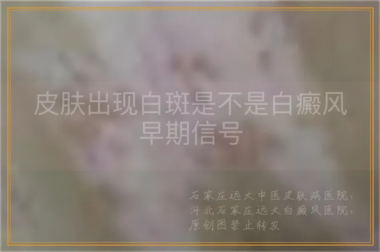 皮肤出现白斑是不是白癜风早期信号