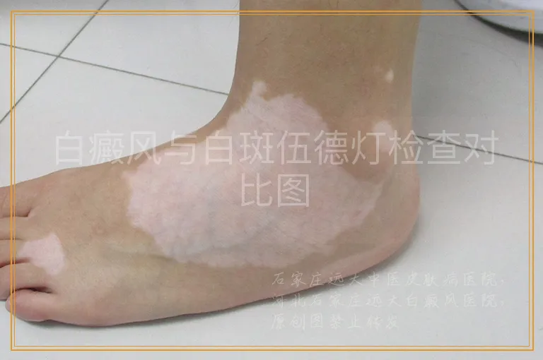 白癜风与白斑伍德灯检查对比图
