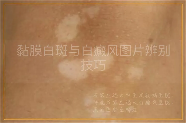 黏膜白斑与白癜风图片辨别技巧