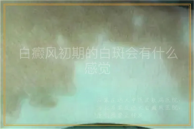 白癜风初期的白斑会有什么感觉