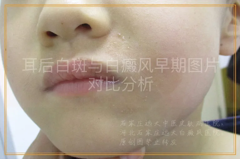 耳后白斑与白癜风早期图片对比分析