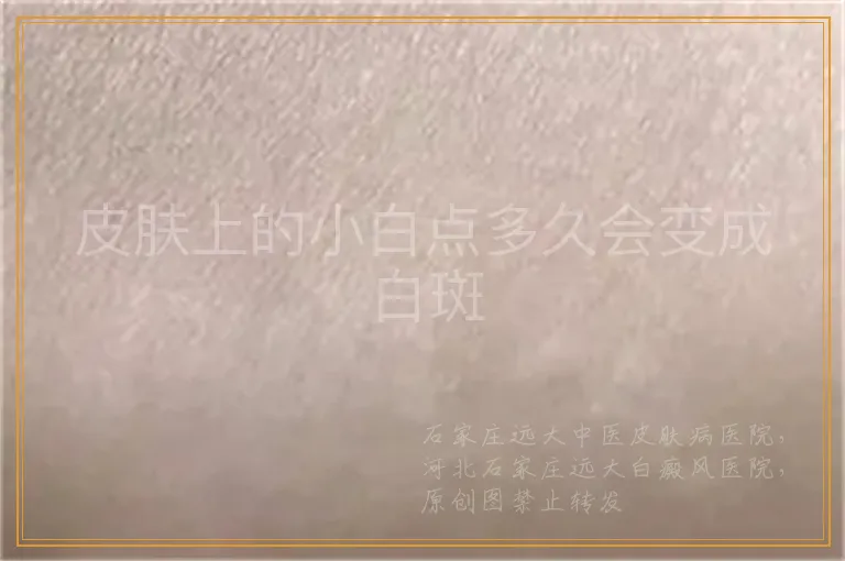 皮肤上的小白点多久会变成白斑