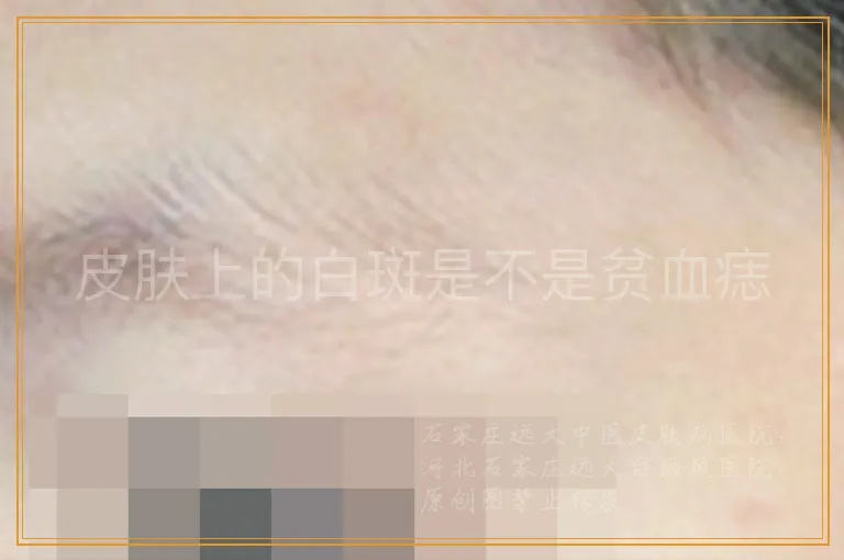 皮肤上的白斑是不是贫血痣