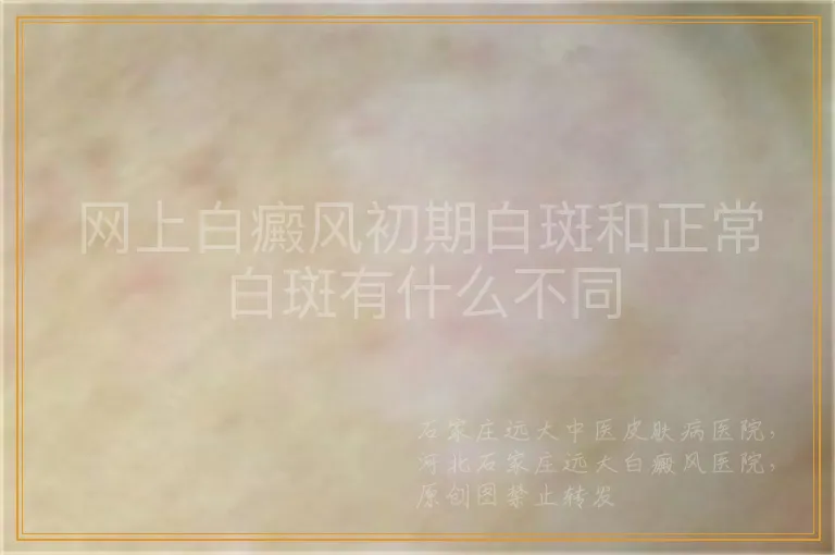 网上白癜风初期白斑和正常白斑有什么不同