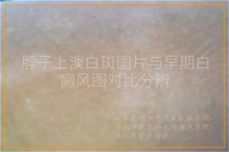 脖子上淡白斑图片与早期白癜风图对比分辨