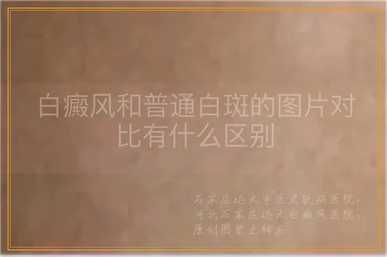 白癜风和普通白斑的图片对比有什么区别