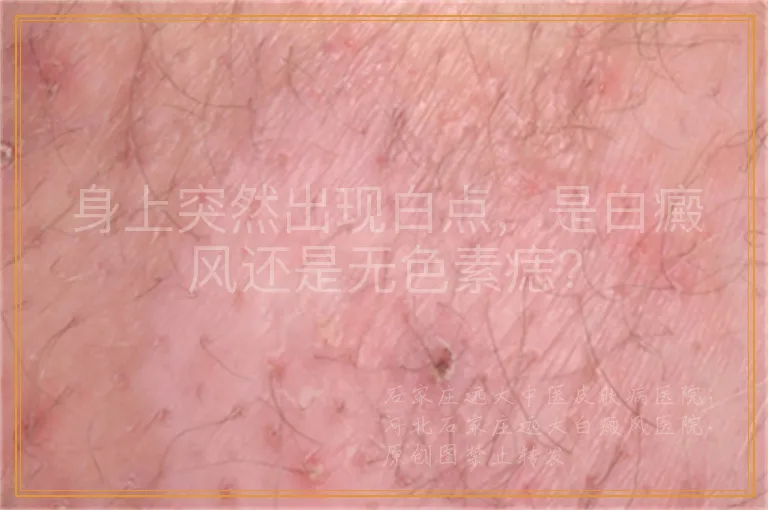 身上突然出现白点，是白癜风还是无色素痣？