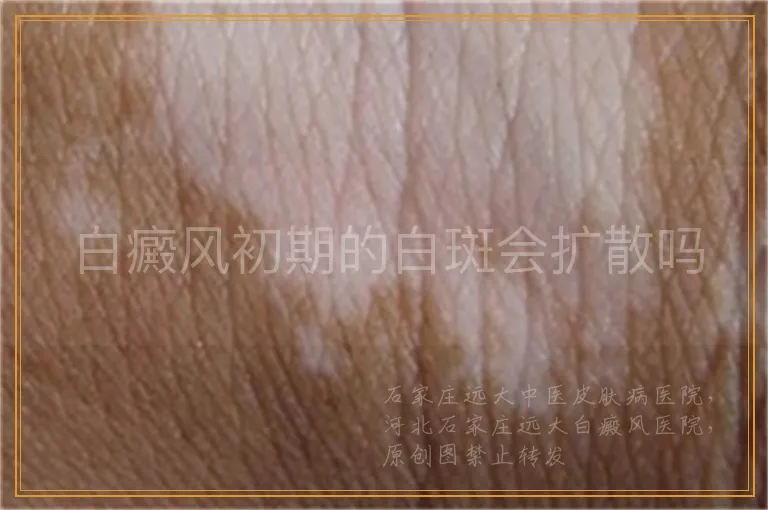 白癜风初期的白斑会扩散吗